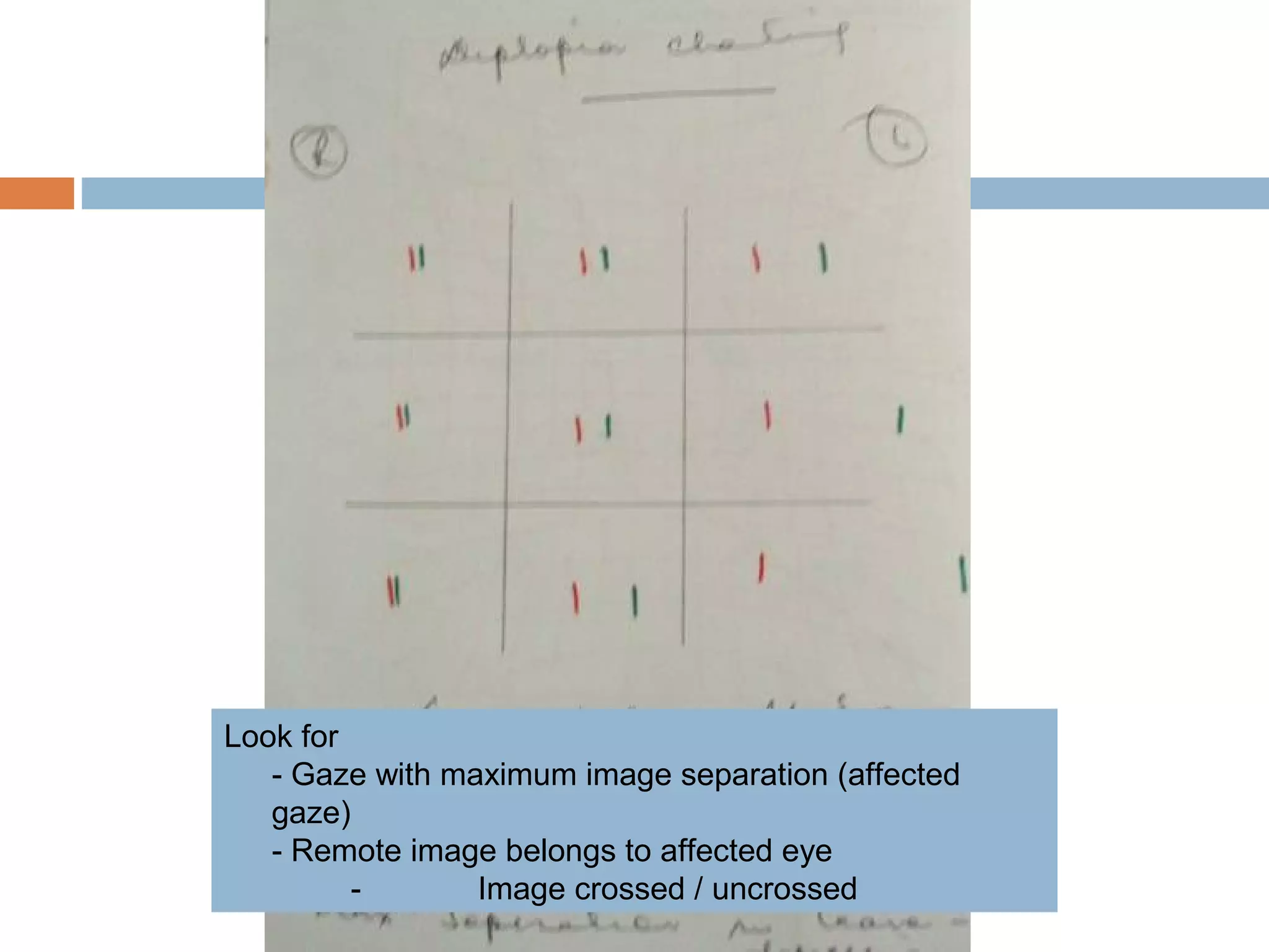 Look for
- Gaze with maximum image separation (affected
gaze)
- Remote image belongs to affected eye
- Image crossed / uncrossed
 