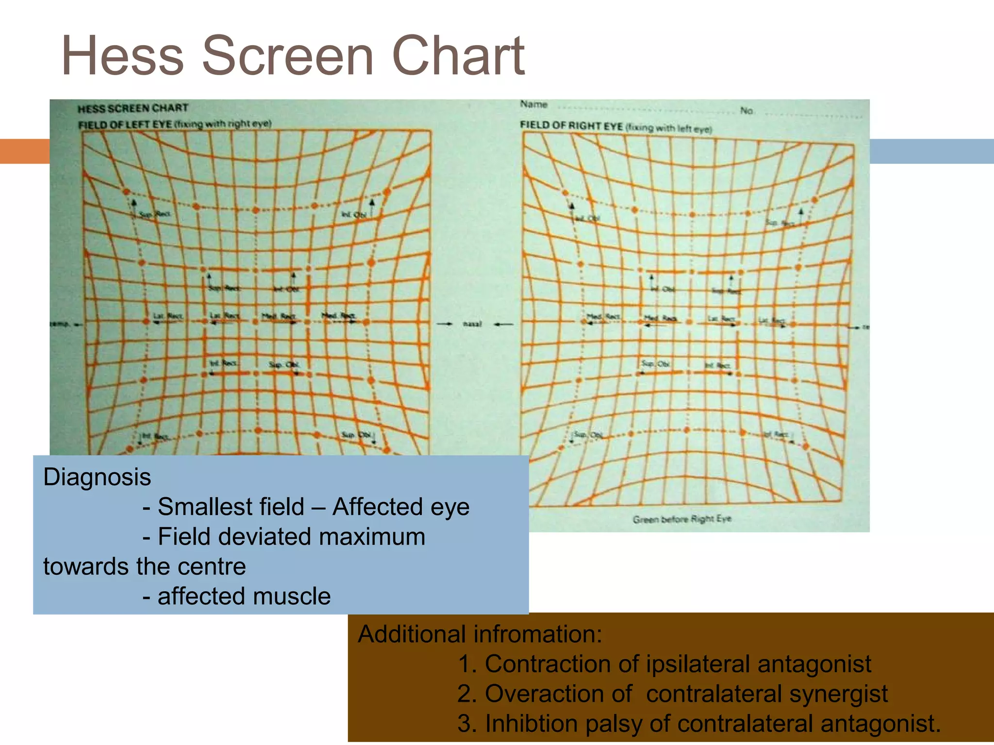 Hess Screen Chart
Additional infromation:
1. Contraction of ipsilateral antagonist
2. Overaction of contralateral synergist
3. Inhibtion palsy of contralateral antagonist.
Diagnosis
- Smallest field – Affected eye
- Field deviated maximum
towards the centre
- affected muscle
 