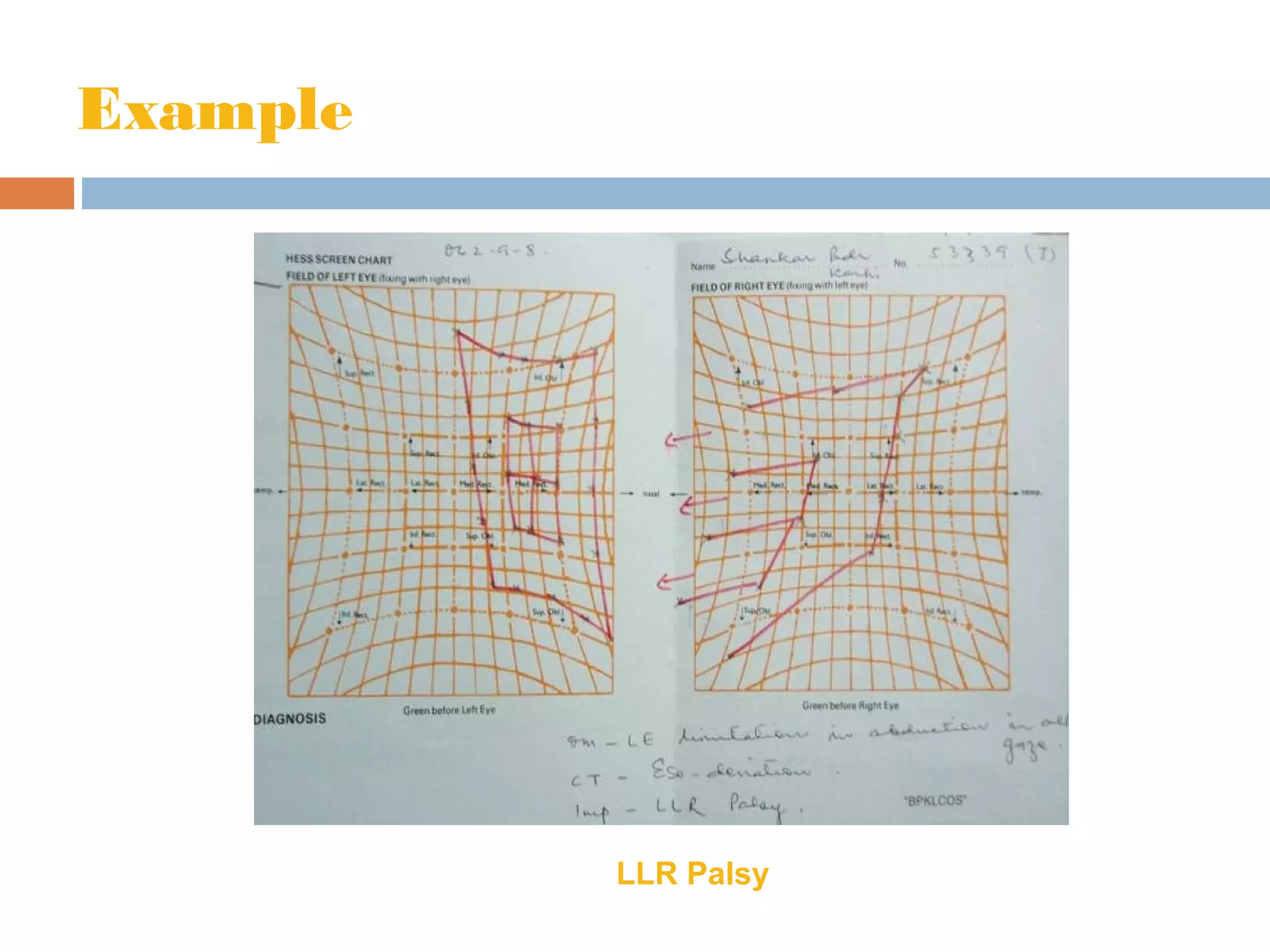 Example
LLR Palsy
 