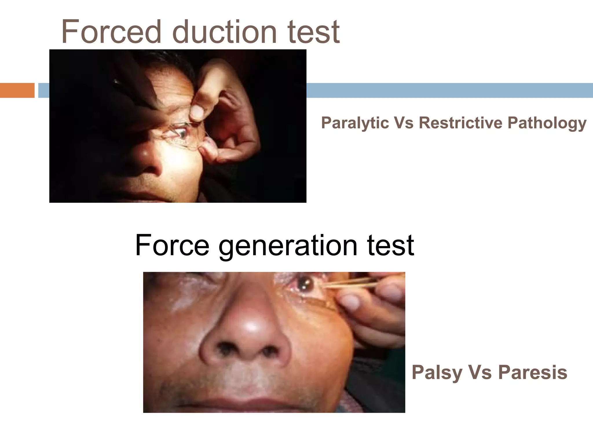 Forced duction test
Force generation test
Palsy Vs Paresis
Paralytic Vs Restrictive Pathology
 