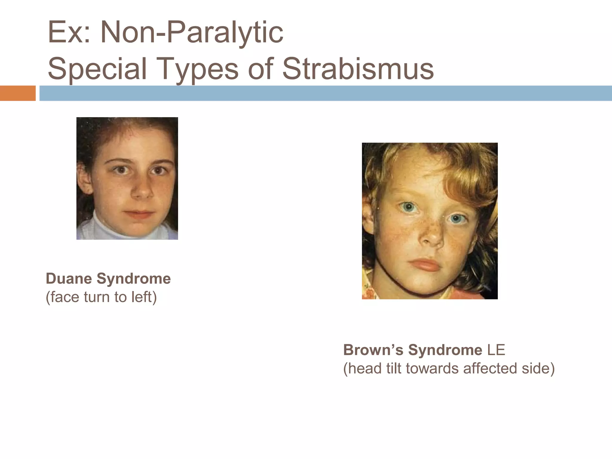 Ex: Non-Paralytic
Special Types of Strabismus
Duane Syndrome
(face turn to left)
Brown’s Syndrome LE
(head tilt towards affected side)
 