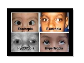 Inconcomitant strabismus types and different tests | PPT