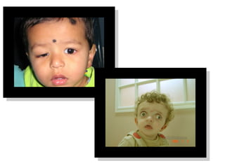 Inconcomitant strabismus types and different tests | PPT