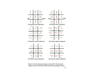 Inconcomitant strabismus types and different tests | PPT