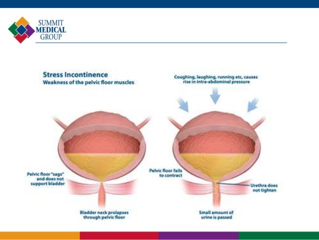overflow incontinence kidn3y stones overflow incontinence kidn3y stones