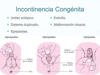Incontinencia Congénita
 Uréter ectópico.

 Extrofia.

 Sistema duplicado.

 Malformación cloacal.

 Epispadias.

 