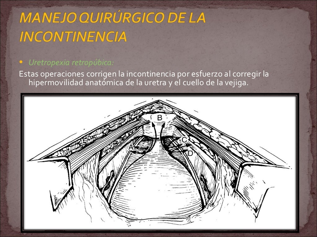 Incontinencia urinaria