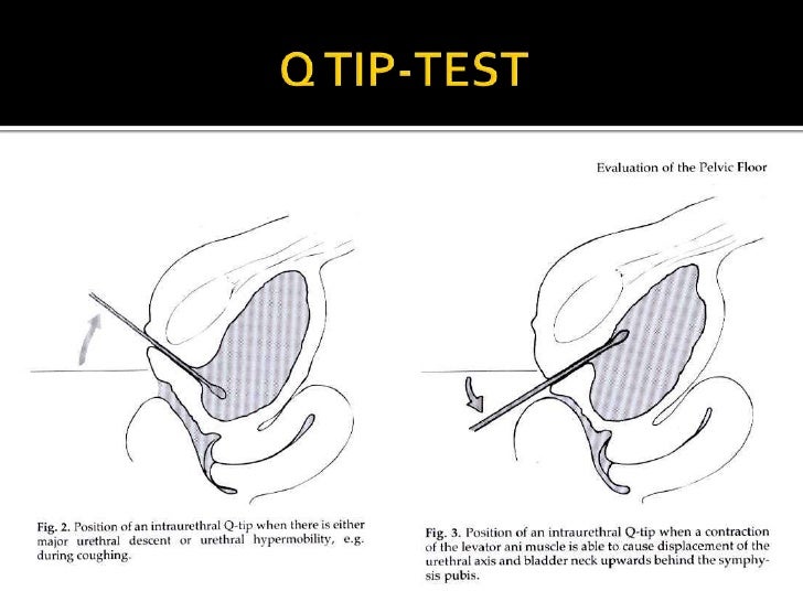 トップ Q Tip Test - ラザダモガ