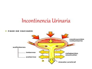 Incontinencia Urinaria
 