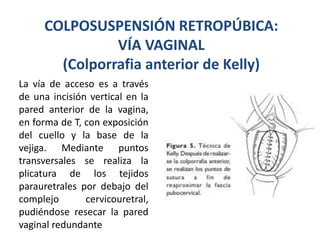 incontinencia urinaria.pptx