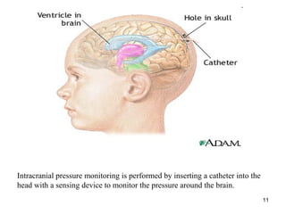 11
Intracranial pressure monitoring is performed by inserting a catheter into the
head with a sensing device to monitor the pressure around the brain.
 