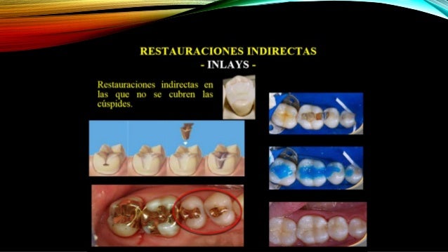 Incrustaciones inlay, onlay y overlay