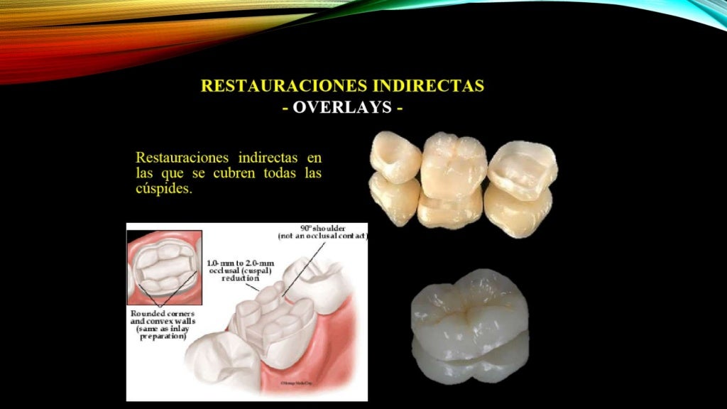 Incrustaciones inlay, onlay y overlay
