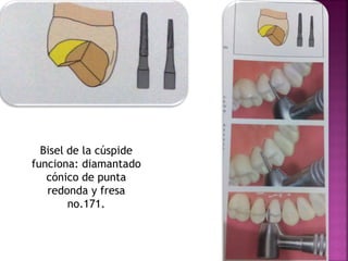 Incrustaciones inlays y onlays | PDF
