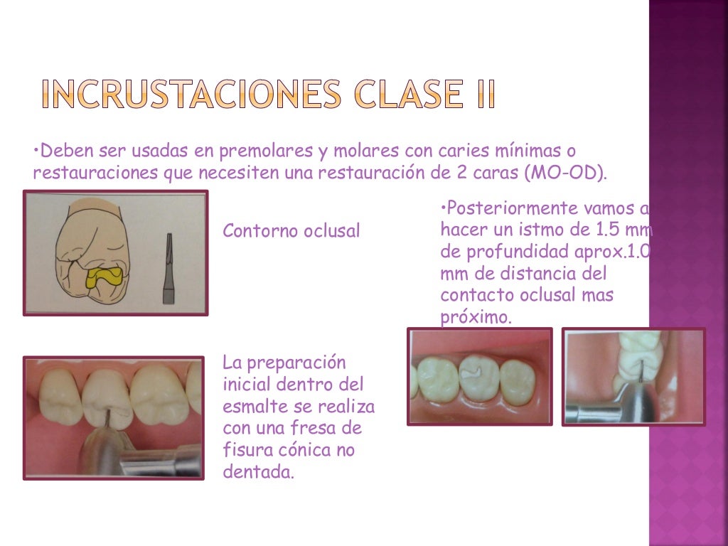 Incrustaciones inlays y onlays