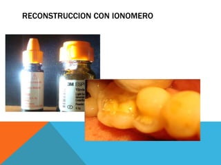 RECONSTRUCCION CON IONOMERO
 