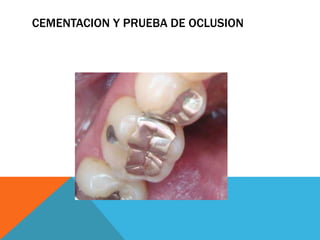 CEMENTACION Y PRUEBA DE OCLUSION
 