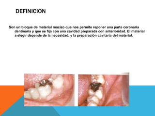 DEFINICION

Son un bloque de material macizo que nos permite reponer una parte coronaria
   dentinaria y que se fija con una cavidad preparada con anterioridad. El material
   a elegir depende de la necesidad, y la preparación cavitaria del material.
 