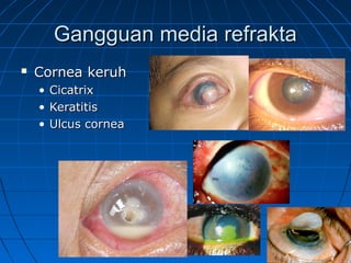 GGaanngggguuaann mmeeddiiaa rreeffrraakkttaa 
 CCoorrnneeaa kkeerruuhh 
• CCiiccaattrriixx 
• KKeerraattiittiiss 
• UUllccuuss ccoorrnneeaa 
 