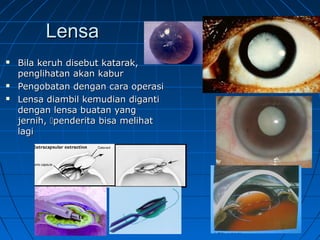 LLeennssaa 
 BBiillaa kkeerruuhh ddiisseebbuutt kkaattaarraakk,, 
ppeenngglliihhaattaann aakkaann kkaabbuurr 
 PPeennggoobbaattaann ddeennggaann ccaarraa ooppeerraassii 
 LLeennssaa ddiiaammbbiill kkeemmuuddiiaann ddiiggaannttii 
ddeennggaann lleennssaa bbuuaattaann yyaanngg 
jjeerrnniihh,, ppeennddeerriittaa bbiissaa mmeelliihhaatt 
llaaggii 
 