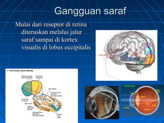GGaanngggguuaann ssaarraaff 
MMuullaaii ddaarrii rreesseeppttoorr ddii rreettiinnaa 
ddiitteerruusskkaann mmeellaalluuii jjaalluurr 
ssaarraaff ssaammppaaii ddii kkoorrtteexx 
vviissuuaalliiss ddii lloobbuuss oocccciippiittaalliiss 
 
