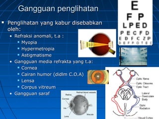 GGaanngggguuaann ppeenngglliihhaattaann 
 PPeenngglliihhaattaann yyaanngg kkaabbuurr ddiisseebbaabbkkaann 
oolleehh:: 
• RReeffrraakkssii aannoommaallii,, tt..aa :: 
 MMyyooppiiaa 
 HHyyppeerrmmeettrrooppiiaa 
 AAssttiiggmmaattiissmmee 
• GGaanngggguuaann mmeeddiiaa rreeffrraakkttaa yyaanngg tt..aa:: 
 CCoorrnneeaa 
 CCaaiirraann hhuummoorr ((ddiiddllmm CC..OO..AA)) 
 LLeennssaa 
 CCoorrppuuss vviittrreeuumm 
• GGaanngggguuaann ssaarraaff 
 