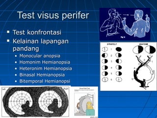 TTeesstt vviissuuss ppeerriiffeerr 
 TTeesstt kkoonnffrroonnttaassii 
 KKeellaaiinnaann llaappaannggaann 
ppaannddaanngg 
• MMoonnooccuullaarr aannooppssiiaa 
• HHoommoonniimm HHeemmiiaannooppssiiaa 
• HHeetteerroonniimm HHeemmiiaannooppssiiaa 
• BBiinnaassaall HHeemmiiaannooppssiiaa 
• BBiitteemmppoorraall HHeemmiiaannooppssii 
 
