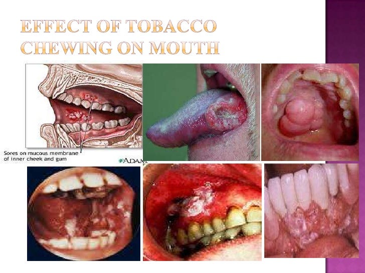 effects of smokeless tobacco on oral effects of smokeless tobacco on oral