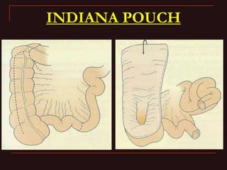 INDIANA pouch for Extrophy Bladder.ppt
