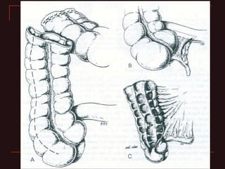 INDIANA pouch for Extrophy Bladder.ppt