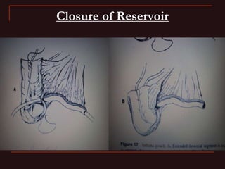 INDIANA pouch for Extrophy Bladder.ppt