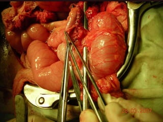 INDIANA pouch for Extrophy Bladder.ppt