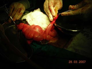 INDIANA pouch for Extrophy Bladder.ppt