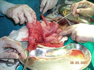 INDIANA pouch for Extrophy Bladder.ppt