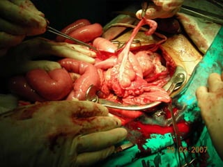 INDIANA pouch for Extrophy Bladder.ppt