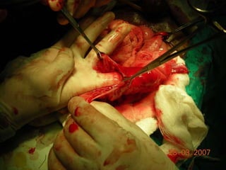 INDIANA pouch for Extrophy Bladder.ppt