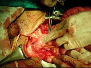 INDIANA pouch for Extrophy Bladder.ppt