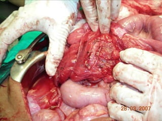 INDIANA pouch for Extrophy Bladder.ppt