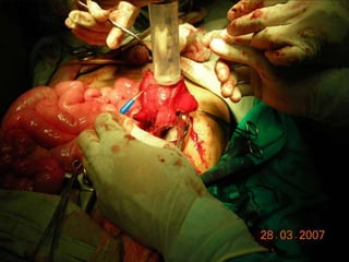 INDIANA pouch for Extrophy Bladder.ppt