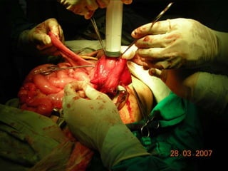 INDIANA pouch for Extrophy Bladder.ppt