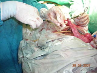 INDIANA pouch for Extrophy Bladder.ppt