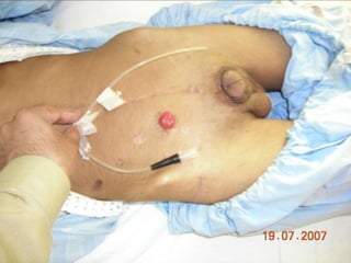 INDIANA pouch for Extrophy Bladder.ppt