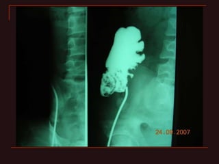 INDIANA pouch for Extrophy Bladder.ppt