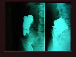 INDIANA pouch for Extrophy Bladder.ppt