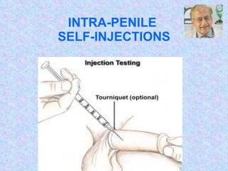 INTRA-PENILE  SELF-INJECTIONS I ntra –  C avernosal  I njection of V aso- A ctive  D rugs 