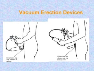 Vacuum Erection Devices 
