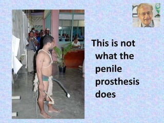 This is not what the penile prosthesis does 