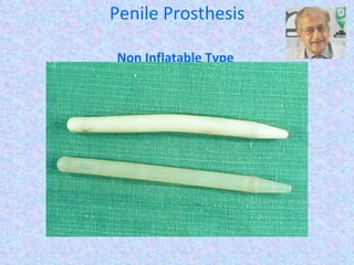 Penile Prosthesis Non Inflatable Type  (Malleable or Flexible) 
