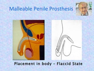 Malleable Penile Prosthesis Placement in body – Flaccid State 