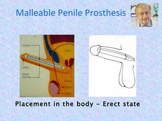 Malleable Penile Prosthesis Placement in the body - Erect state 